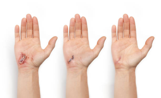 Wound Suturing & Repair - Velura Clinic